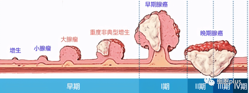 重大爭議有答案！全身用同種異體間充質(zhì)干細胞不會(huì )加重癌前病變發(fā)展