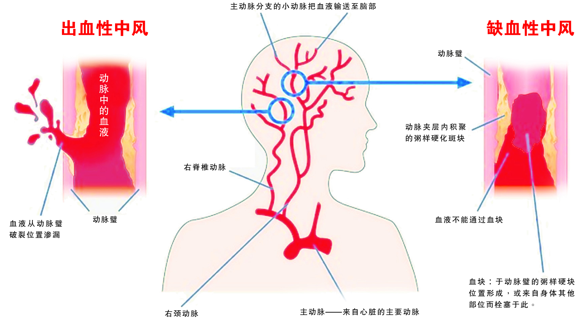 干細胞治療腦卒中的臨床試驗研究進(jìn)展