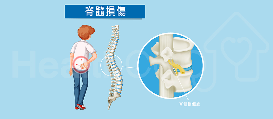 不同類(lèi)型不完全性脊髓損傷的最佳治療方法 不同類(lèi)型不完全性脊髓損傷的最佳治療方法