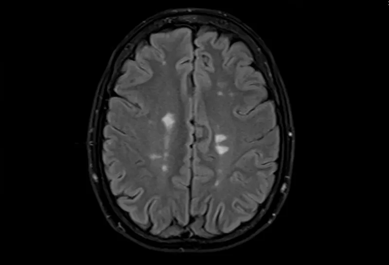 多發(fā)性腦硬化癥的磁共振成像，軸位Flair視圖