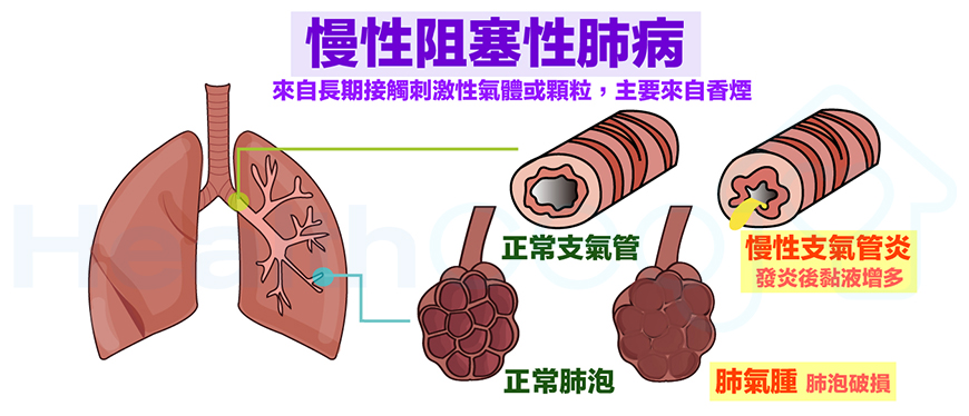 使用干細胞治療慢性阻塞性肺病的一例病例 使用干細胞治療慢性阻塞性肺病的一例病例
