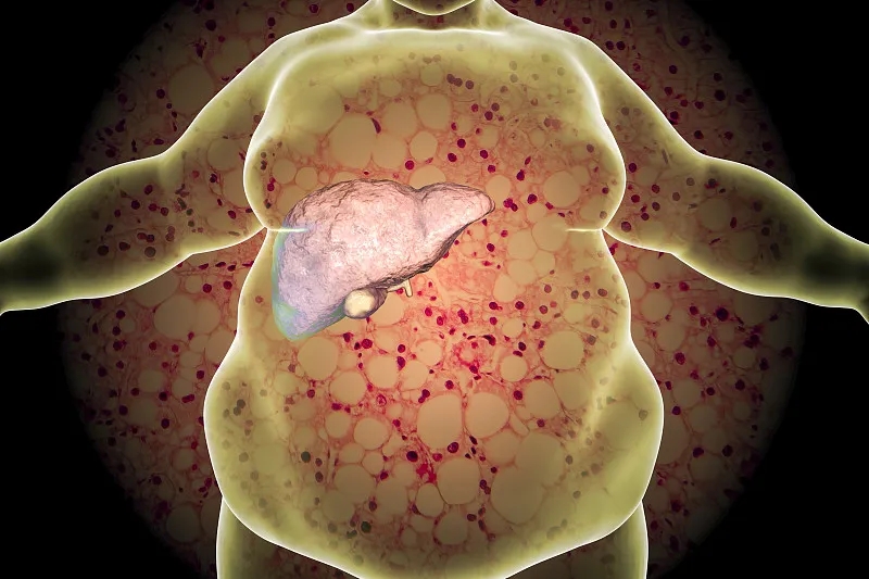 什么是非酒精性脂肪肝(NAFLD) 什么是非酒精性脂肪肝(NAFLD)