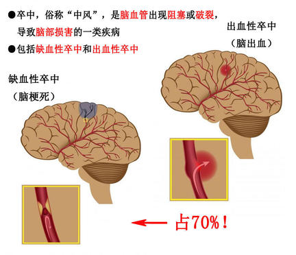 什么是“中風(fēng)”：即是腦卒中，醫學(xué)上也稱(chēng)“急性腦血管病”，俗稱(chēng)“中風(fēng)”。