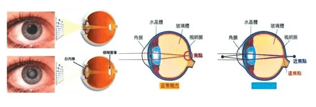 干細胞治療兒童白內障臨床案例 干細胞治療兒童白內障臨床案例