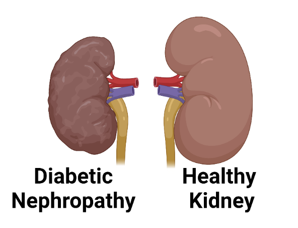 糖尿病腎病的新希望：干細胞療法的臨床研究和應用