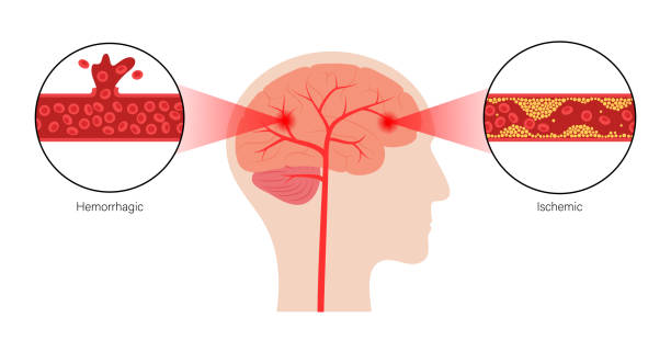 缺血性腦卒中 缺血性腦卒中