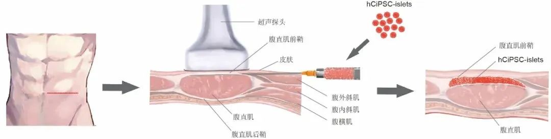 圖2：胰島細胞腹直肌前鞘下移植的示意圖