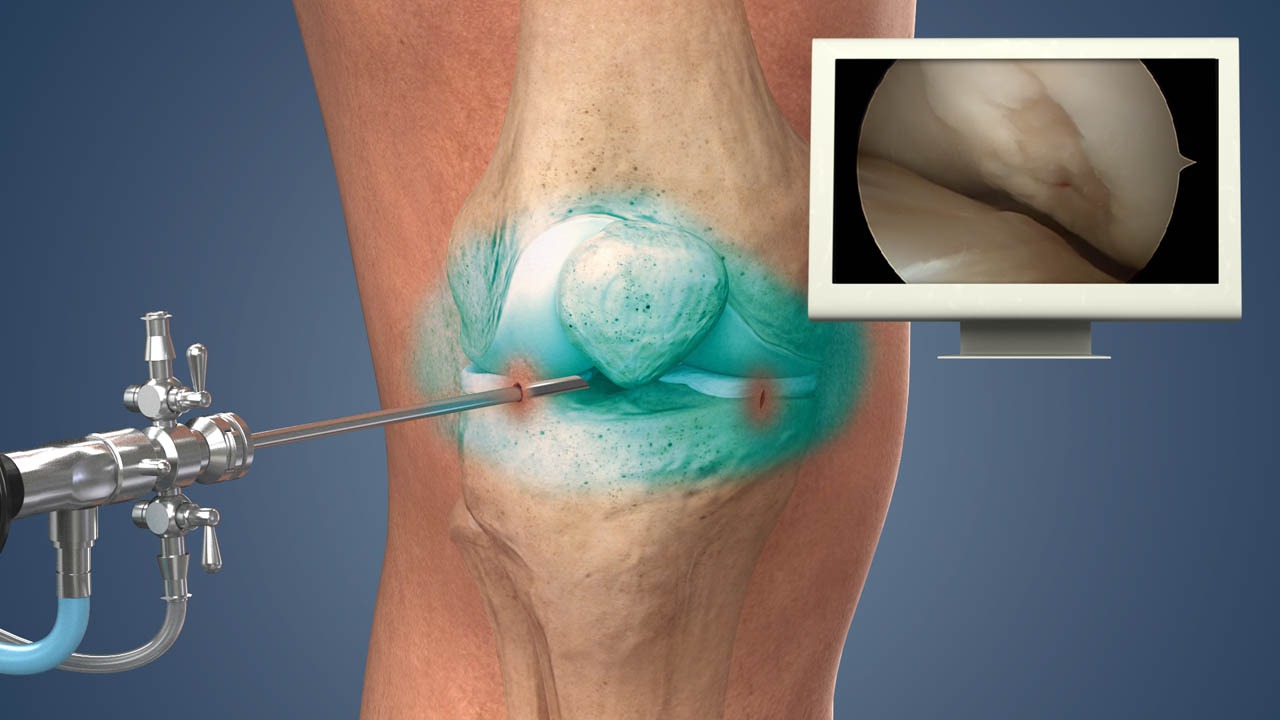 半月板損傷如何治療？為什么干細胞治療半月板損傷更有優(yōu)勢？