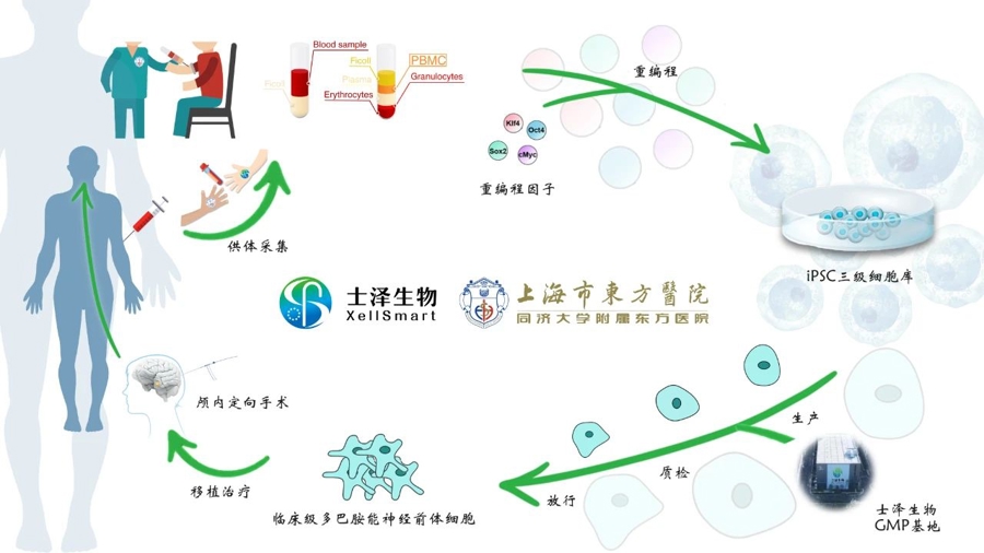 2024年11月，國內首個(gè)iPSC衍生細胞治療帕金森病的臨床研究取得突破性進(jìn)展