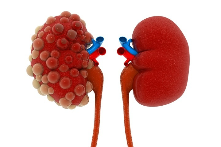 干細胞治療腎病，為患者延緩腎衰竭和提高生活治療帶來(lái)新希望