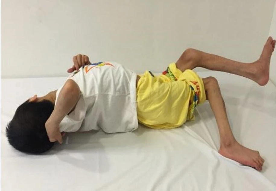 痙攣性腦癱