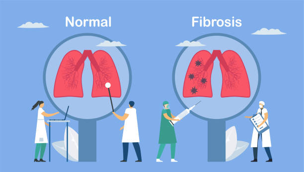 肺纖維化新突破！301醫院聯(lián)合清華全球首發(fā)干細胞霧化療法，晚期患者明顯好轉