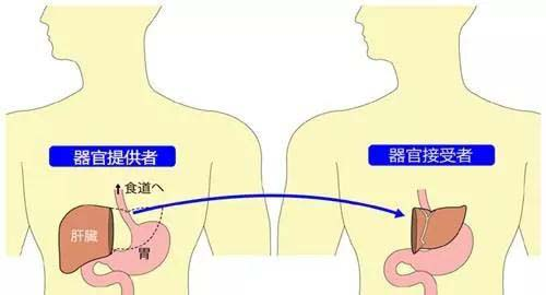 肝移植