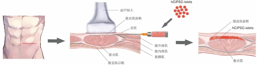 胰島細胞腹直肌前鞘下移植的示意圖